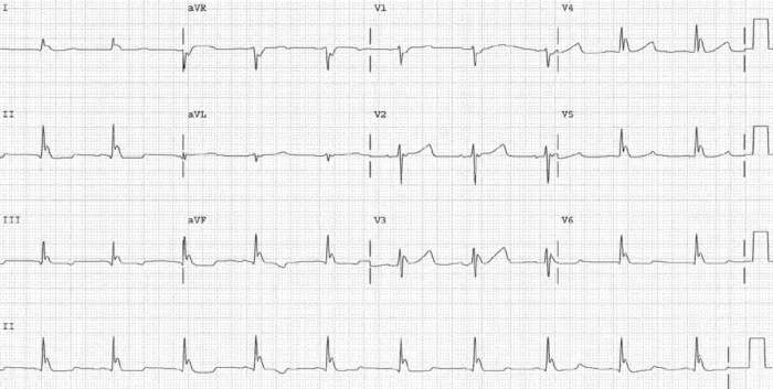 Read more about the article ECG Case 165