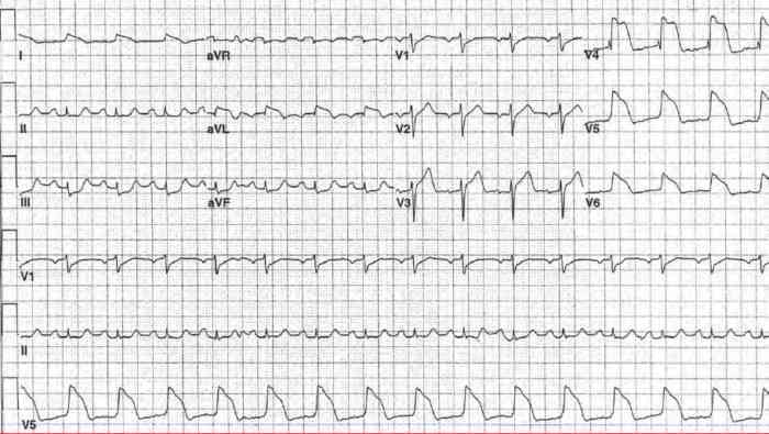 Read more about the article ECG Case 166