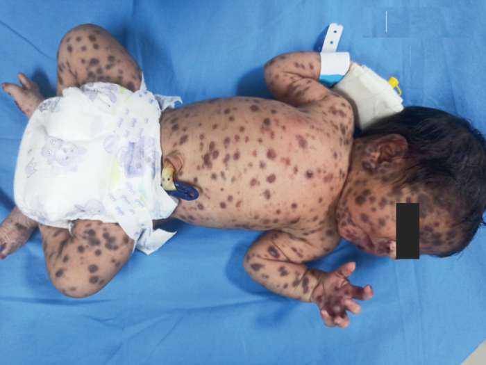 Read more about the article Infant with “Blueberry Muffin” Rash
