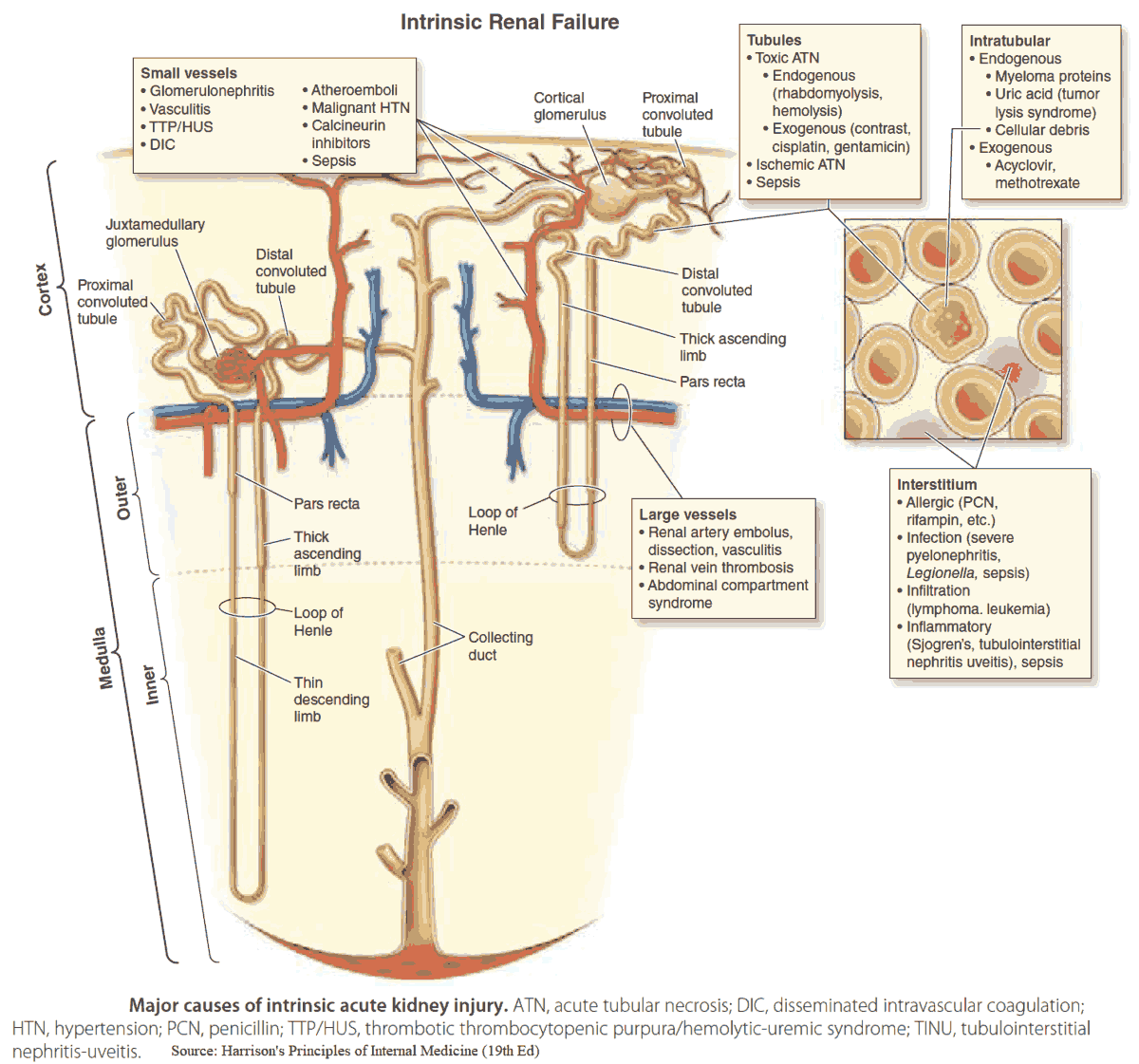 Major causes of intrinsic acute kidney injury (AKI)