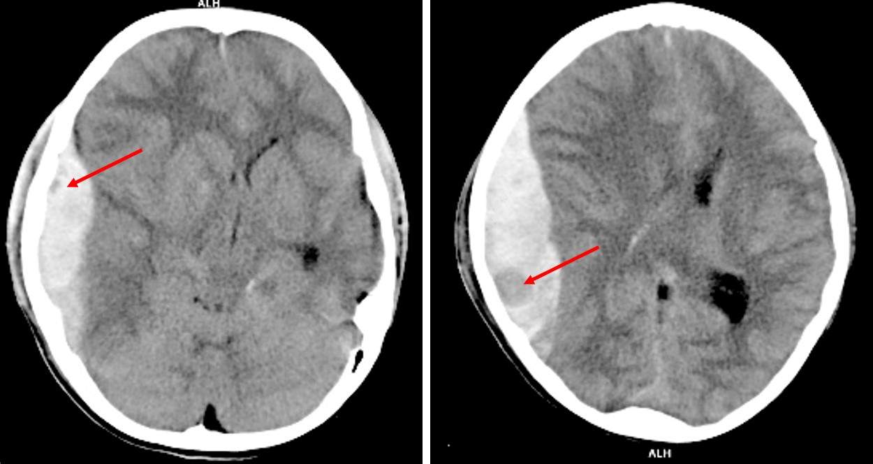 Swirl Sign in Acute Dubdural Hemorrhage