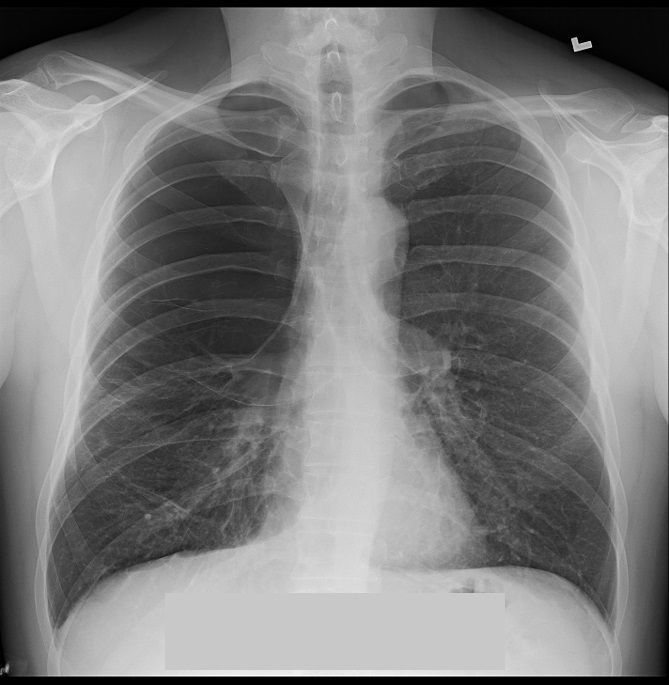 Chest X-ray showing thin-walled lucency predominantly in the apical regions