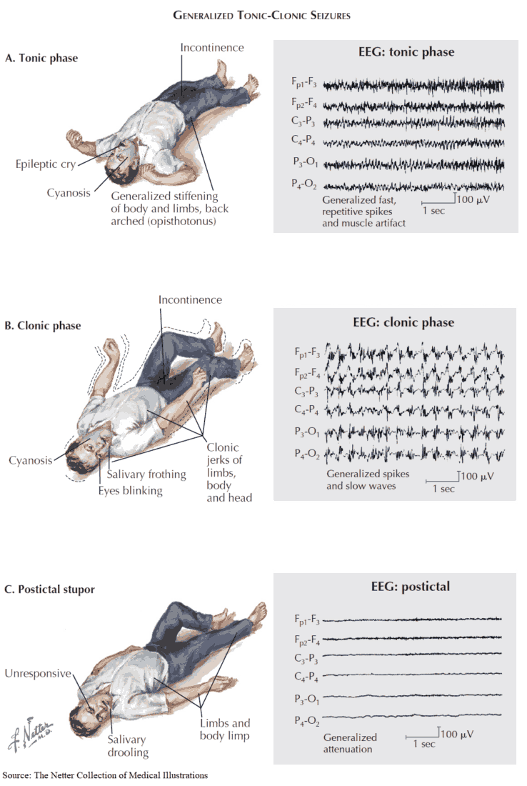 Symptoms and Clinical Manifestations of Generalized Tonic-Clonic Seizures (Epilepsy)