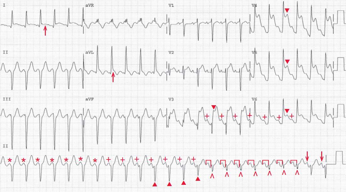 Acute Anterolateral STEMI with Sinus and Ventricular Tachycardia