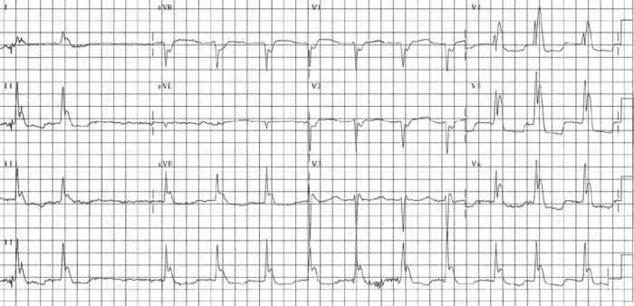 Read more about the article ECG Case 168