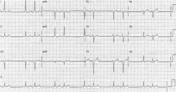 Read more about the article ECG Case 169