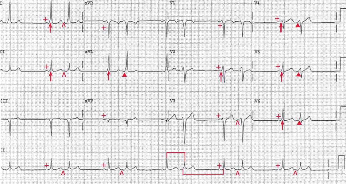 Normal sinus rhythm, Wolff-Parkinson-White pattern, premature atrial complexes with increased preexcitation atrial bigeminy