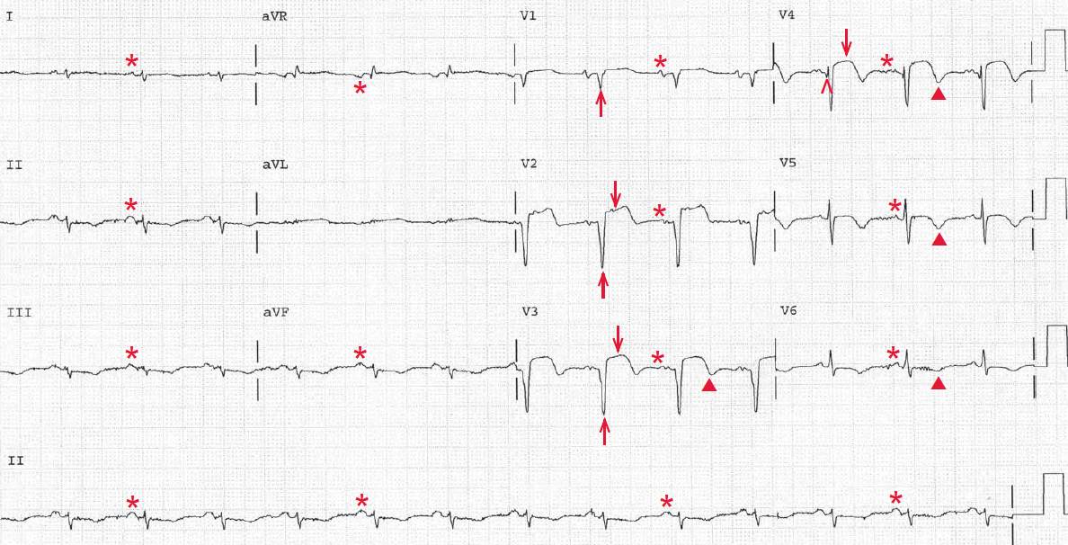 Normal sinus rhythm, left anterior fascicular block, old anterior wall myocardial infarction (MI), ST-segment elevation due to LV aneurysm