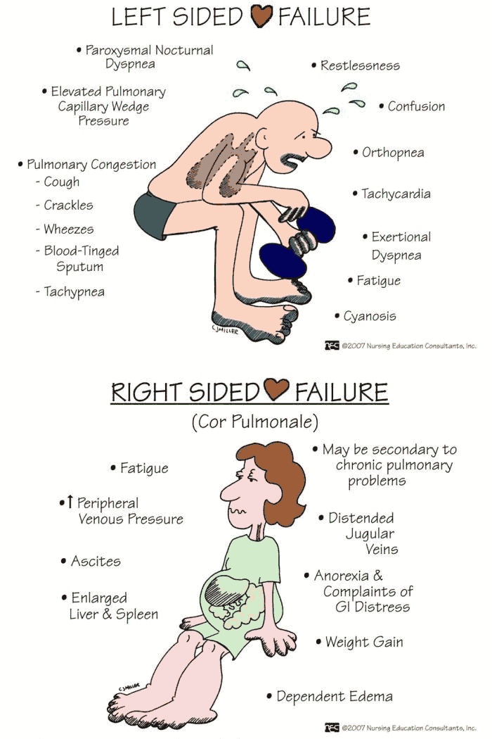 Symptoms and Signs of Left vs Right Heart Failure