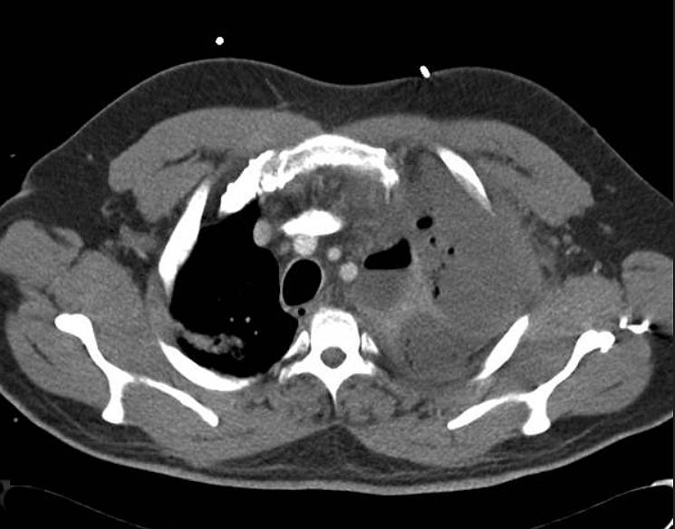 CT thorax demonstrates large left pleural collection with very little aerated left lung. Multiple pockets of gas seen within the collection