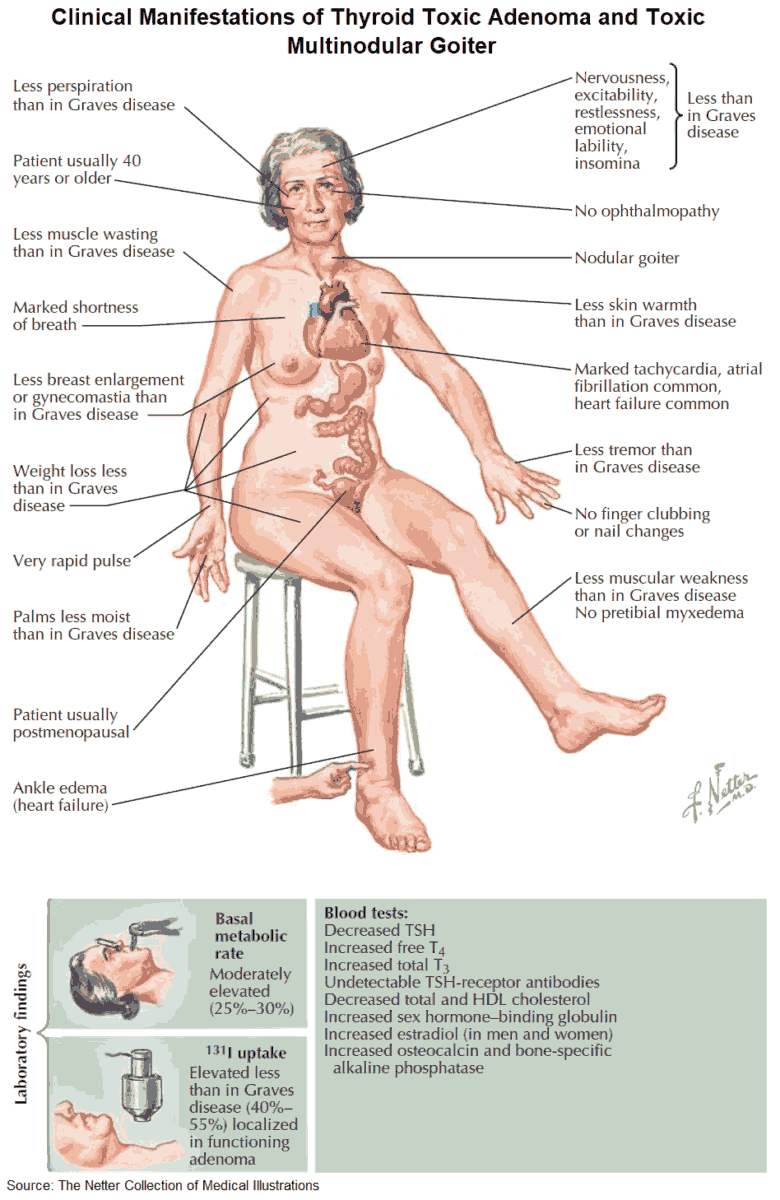 Clinical Manifestations of Hyperthyroidism and Thyrotoxicosis (Thyroid Toxic Adenoma and Toxic Multinodular Goiter)