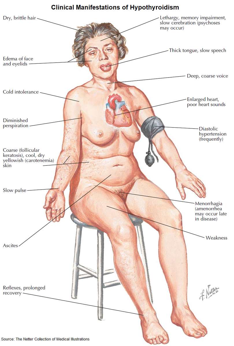 Clinical Manifestations (symptoms and signs) of Hypothyroidism