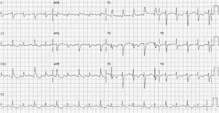 Read more about the article ECG Case 171