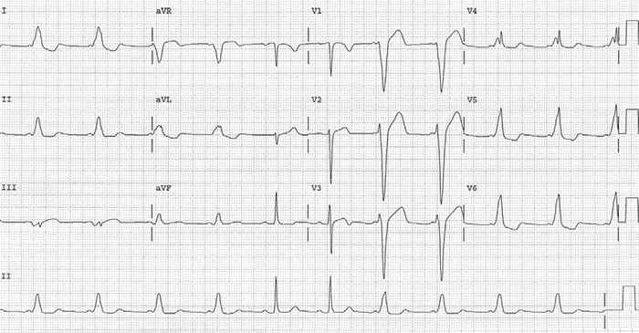Read more about the article ECG Case 172