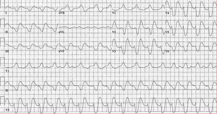 Read more about the article ECG Case 174