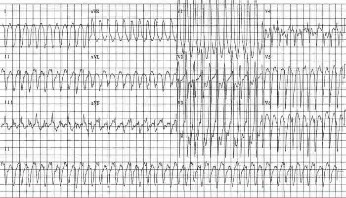 Read more about the article ECG Case 175