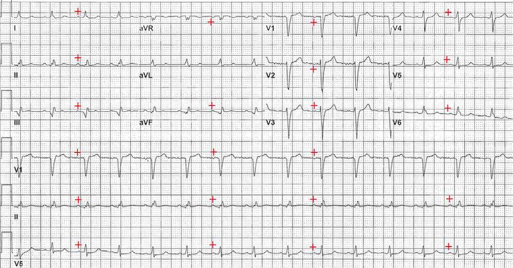 ECG obtained after therapy for hyperkalemia was given and the potassium level corrected