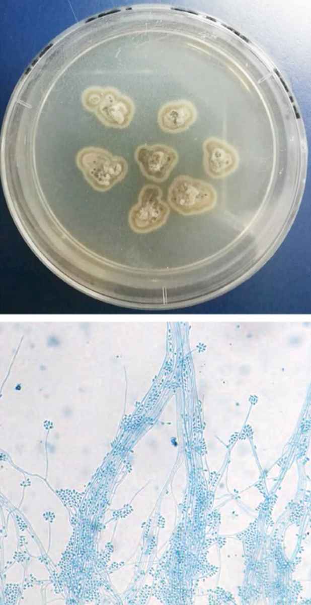 Fungal Culture showing Sporothrix schenckii (Panel B shows a macroscopic view, and Panel C a microscopic view [lactophenol cotton-blue stain])