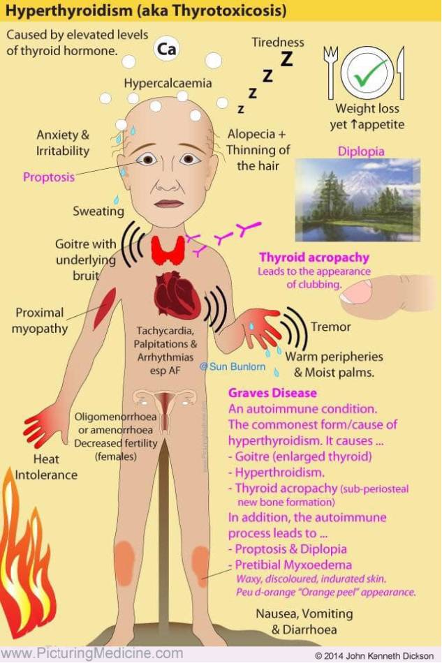 Hyperthyroidism (Thyrotoxicosis) - Symptoms and Signs