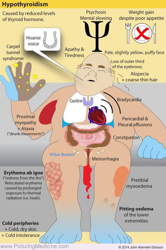 Hypothyroidism - symptoms and signs