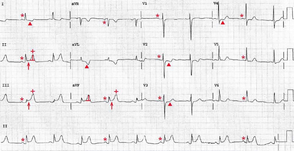 Inferior wall STEMI with posterior wall involvement