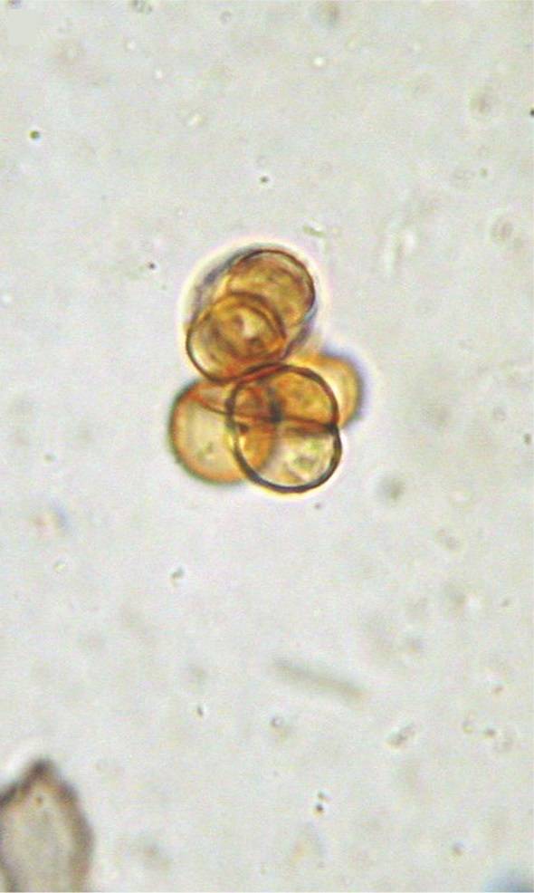 Examination of a skin scraping prepared with 10% potassium hydroxide revealed pigmented, thick-walled, multicellular structures known as Medlar bodies (also called sclerotic cells), a finding that suggested chromoblastomycosis