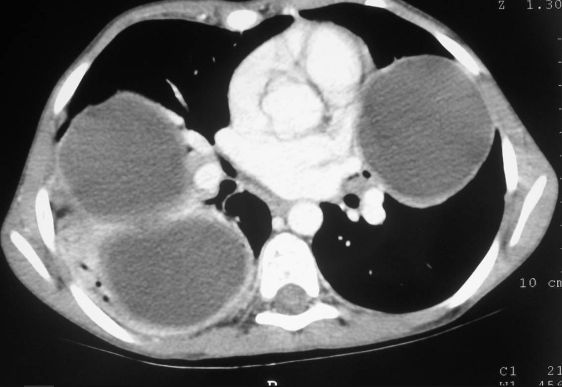 CT Multislice CT of the thorax, soft tissue window. Multiple cyst of the lung. Discrete atelectasis posterior to the cyst.