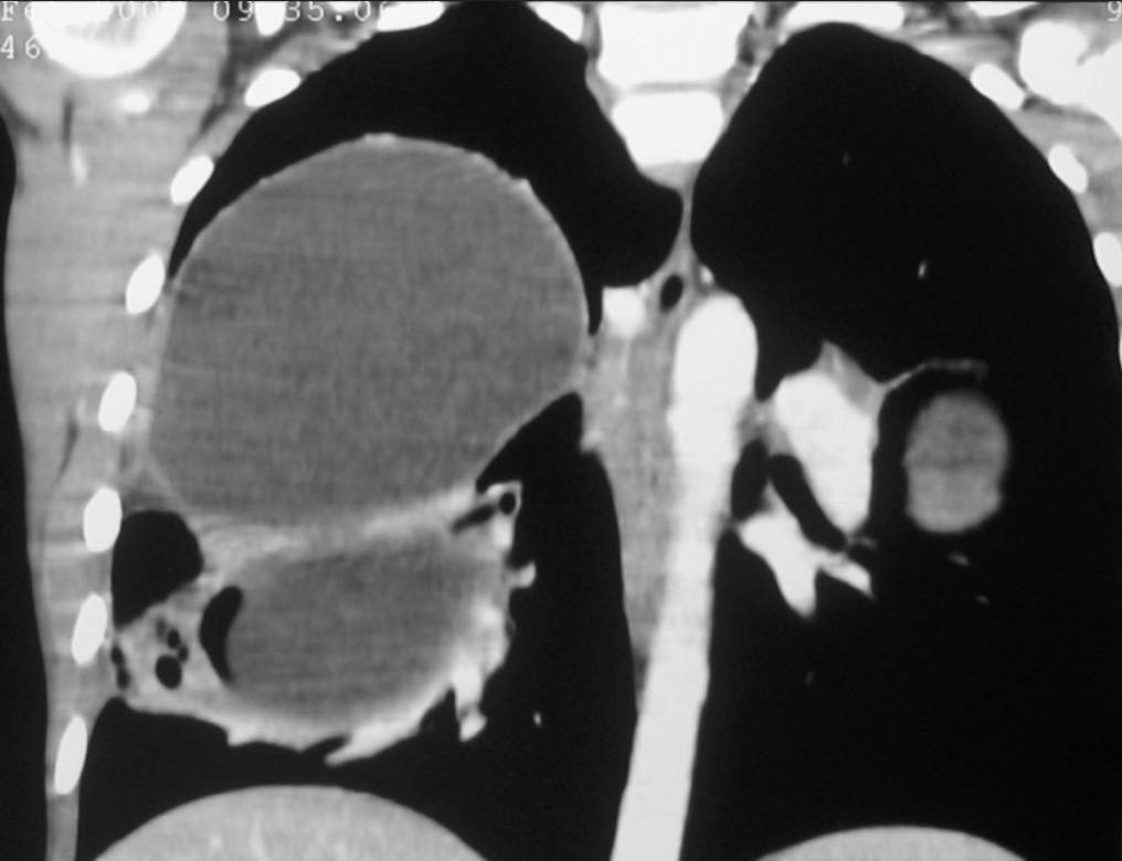 Multislice CT of the thorax, coronal reconstruction.