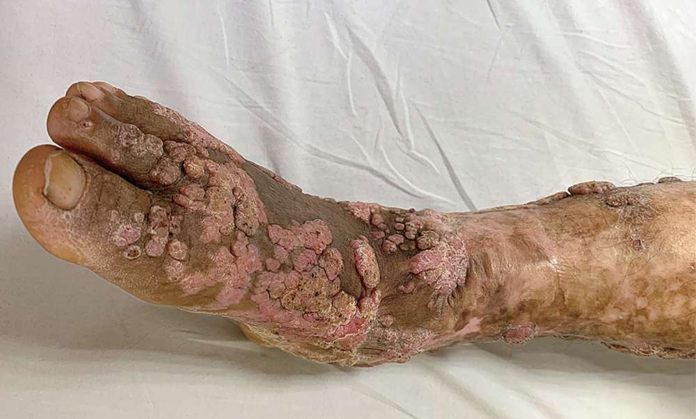Read more about the article Painless, Pruritic Papules and Verrucous Lesions