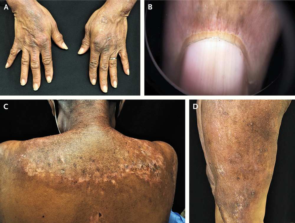 Skin changes in Dermatomyositis