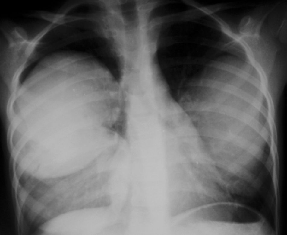 Chest Pain and Dyspnea in 9yearold Boy Manual of Medicine