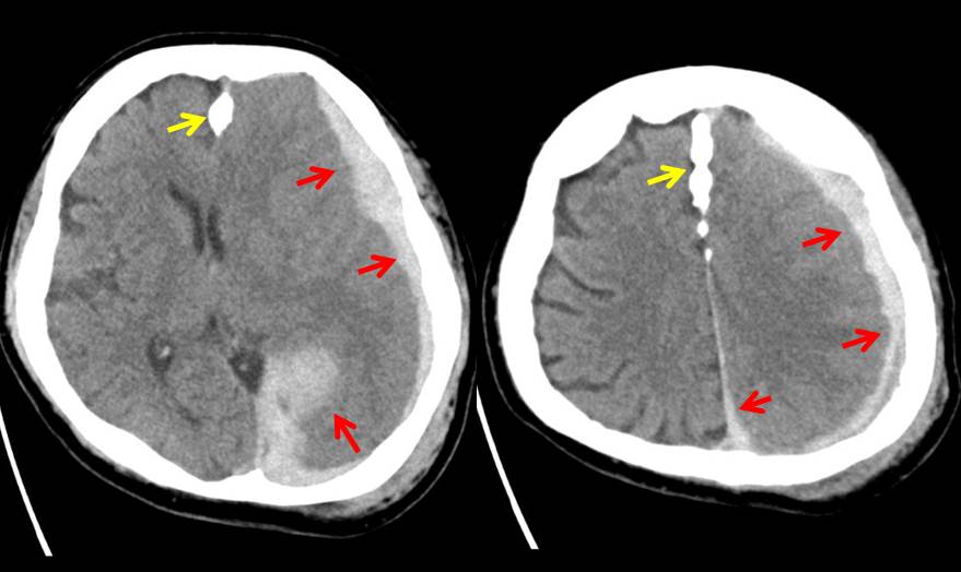 Read more about the article A 59-Year-Old Man After a Fall at Home