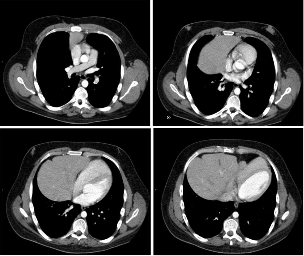 Axial CT images through lower thorax with intravenous contrast demonstrating the herniation of the left lobe of the liver together with the Gallbladder,and part of the stomach and transverse colon into the thorax via a ventral diaphragmatic defect