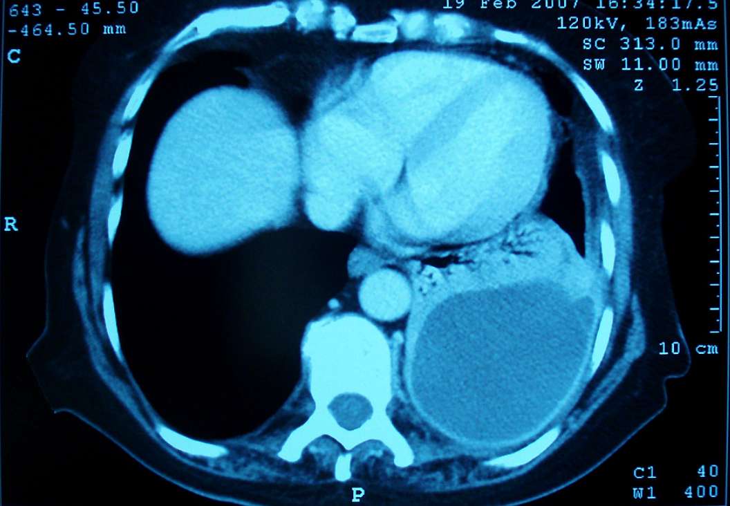 Fluid and air-filled cavity at the left lung base with an enhancing thick wall on axial chest CT