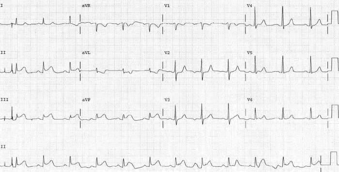Read more about the article ECG Case 176