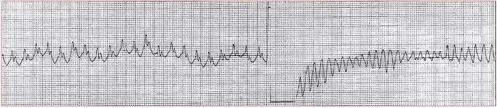 Read more about the article ECG Case 178