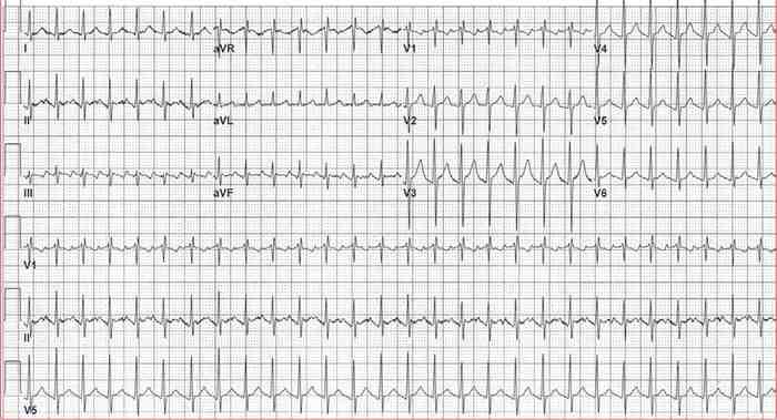 Read more about the article ECG Case 180