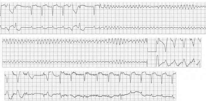 Read more about the article ECG Case 181