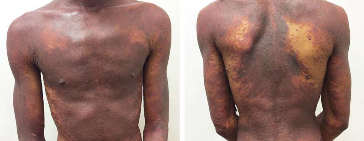 Read more about the article Erythematous, Violaceous Plaques on 90% of the Patient’s Body