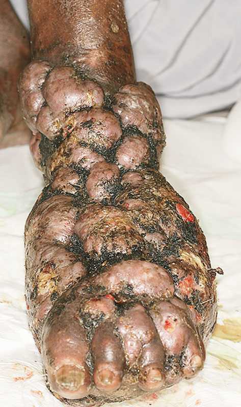 Read more about the article Multinodular Tumor of Left Foot