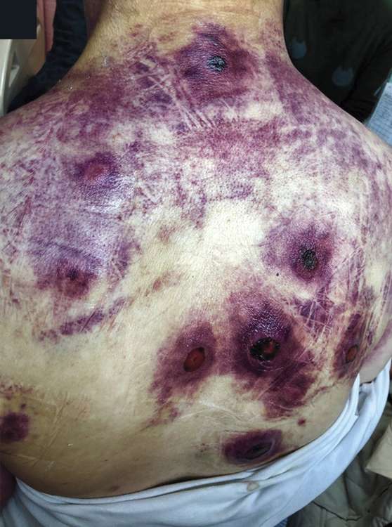 Read more about the article Painful, Indurated Nodules with Purple Discoloration