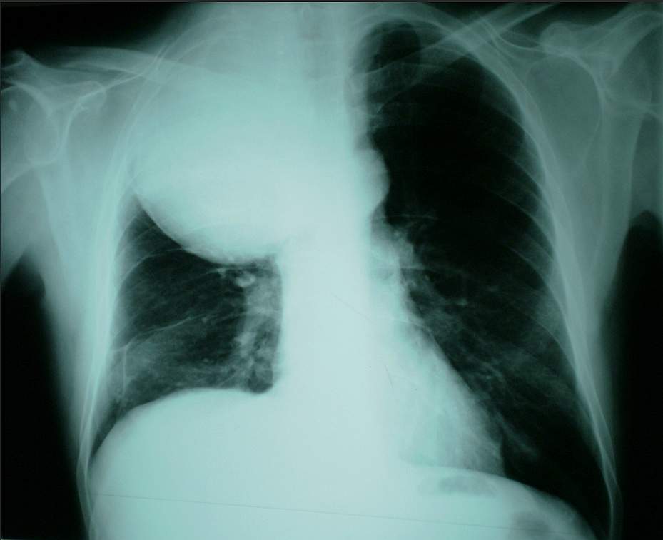 Right upper lobe mass and elevated right diaphragm suggesting right diaphragmatic nerve invasion