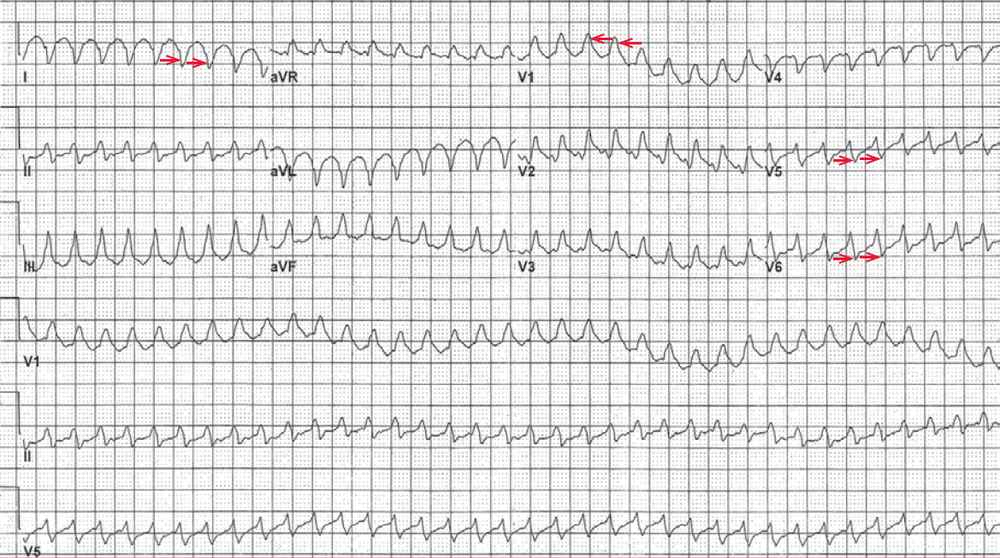 Atrial Flutter with 1:1 Conduction