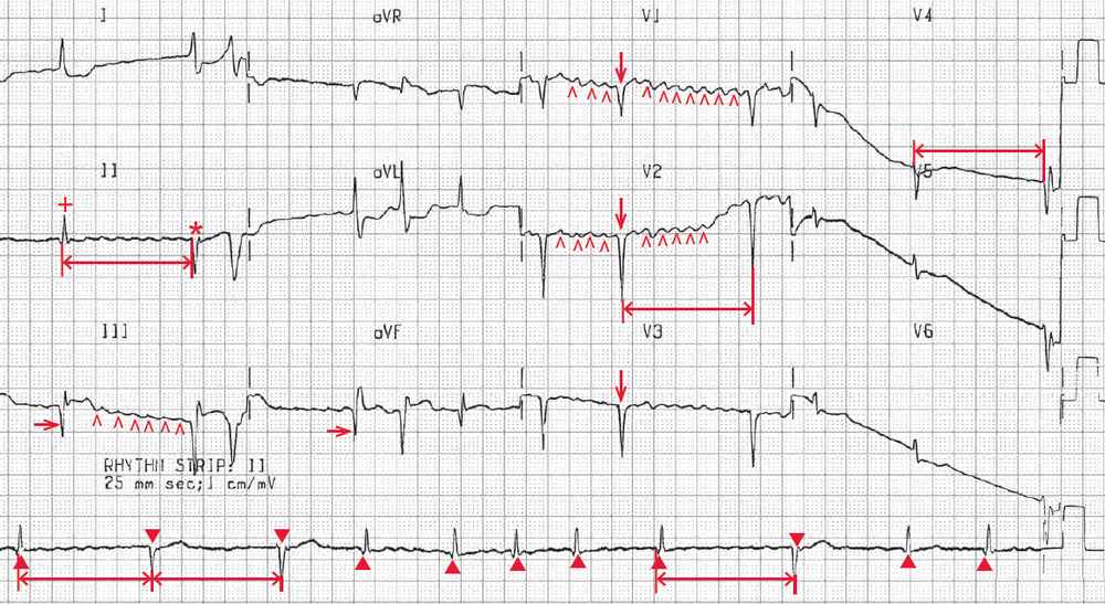 Atrial fibrillation, intermittent regularization due to complete heart block with an escape junctional rhythm, old anteroseptal myocardial infarction, old inferior wall myocardial infarction