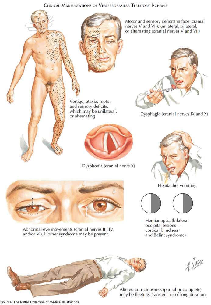 Clinical Manifestations of Vertebrobasilar Territory Ischemia (Stroke)