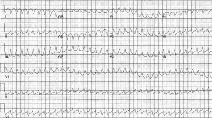 Read more about the article ECG Case 183