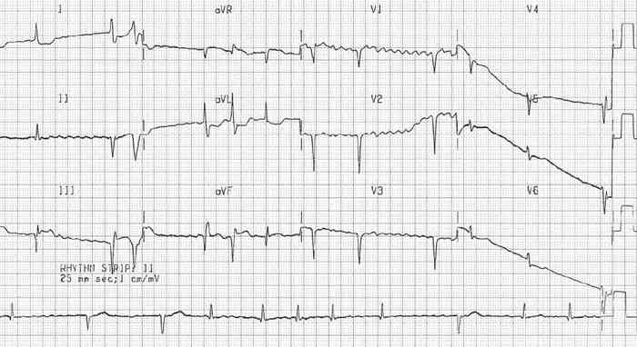 Read more about the article ECG Case 185