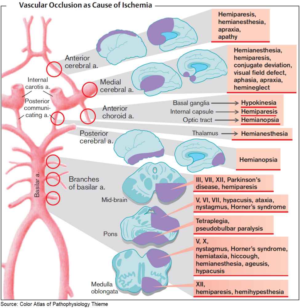Stroke Symptoms and Signs by Vascular Territory