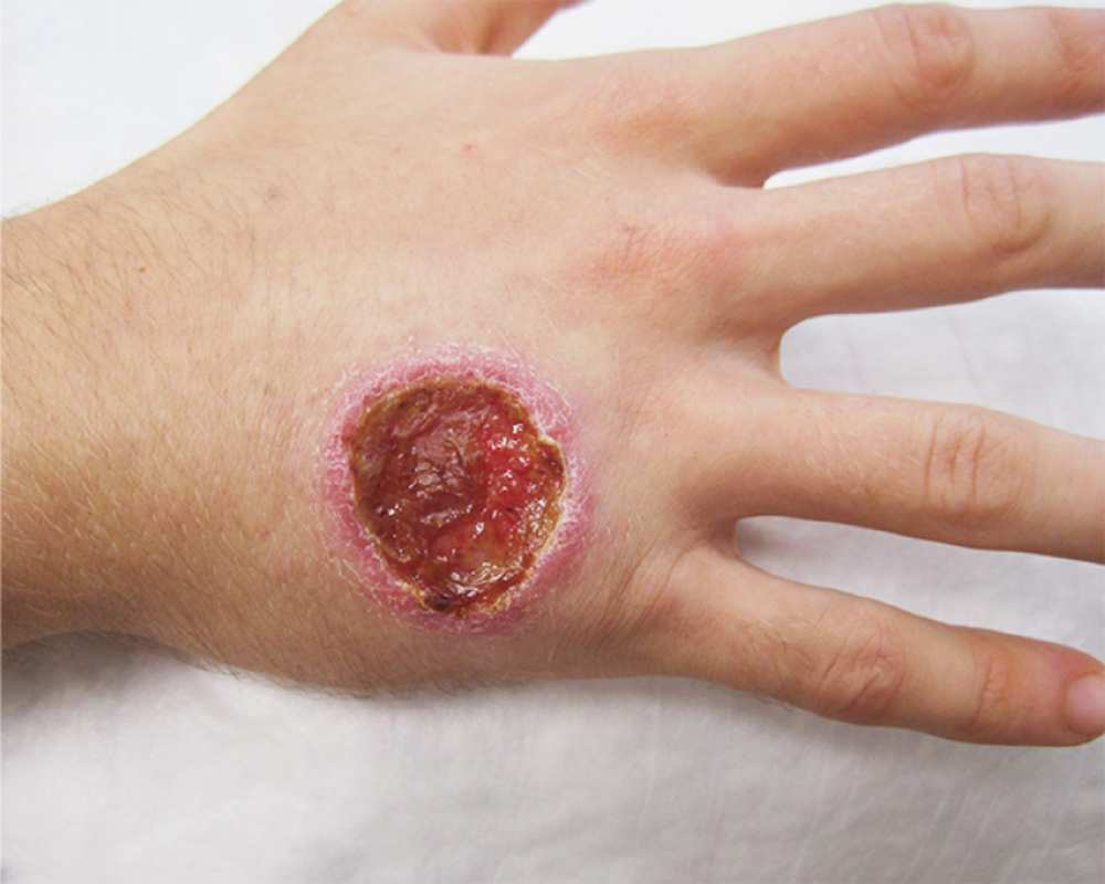 Read more about the article Ulcer and Subcutaneous Nodules