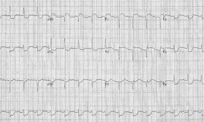 Read more about the article ECG Case 186